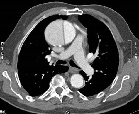 Aortic dissection CT - wikidoc