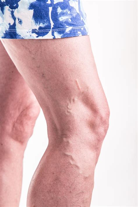 Why Some People Get Varicose Veins and Others Don't: North Atlanta ...