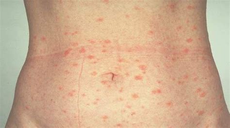 What is Pityriasis rosea? Pityriasis rosea (say "pih-tih-RY-uh-sus ROH-zee-uh") is a common skin ...