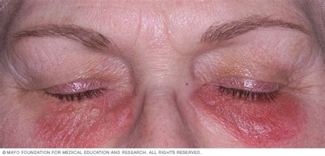 Contact dermatitis - Symptoms and causes - Mayo Clinic