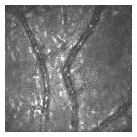 Analysis of corneal vascularisation in moderate (a) and advanced (b ...