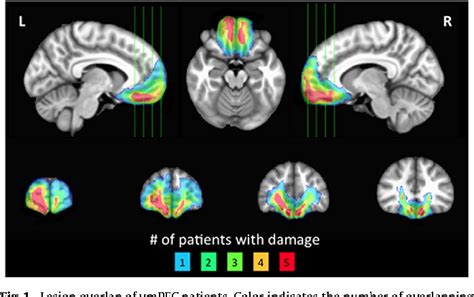 Figure 1 from Ventromedial prefrontal cortex damage alters relative ...