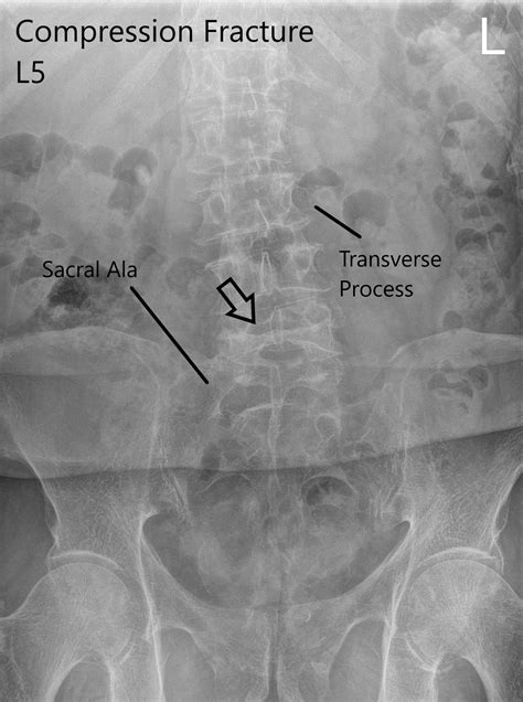 Vertebral Fracture