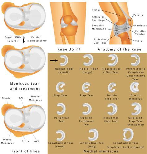 Meniscal injuries - Sports & Spinal Albury %%primary_category%% Sports & Spinal Albury