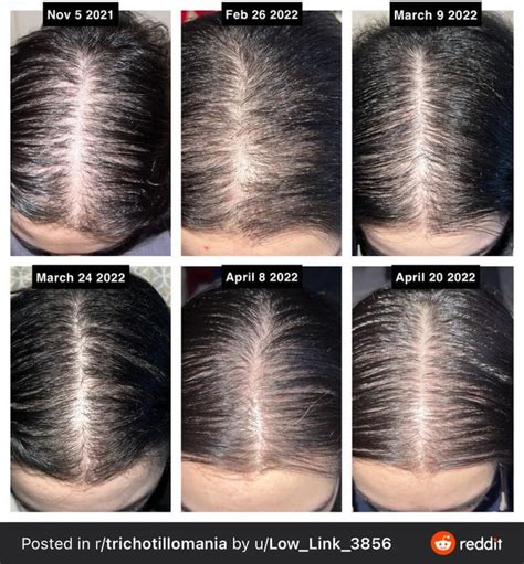 Rosemary Oil for Hair Growth Before and After Results: Here's What to