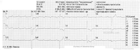 Third-degree AV Block (Complete Heart Block) | ECG Guru - Instructor Resources