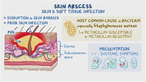 Skin abscess: Clinical sciences - Osmosis Video Library