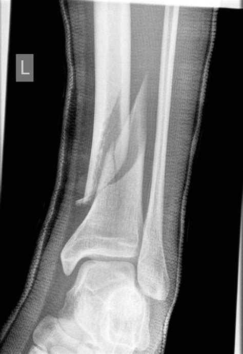 Spiral fracture definition, causes, symptoms, treatment & recovery time