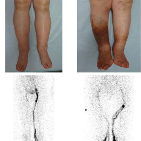 Representative pictures of the legs with dependent edema and... | Download Scientific Diagram