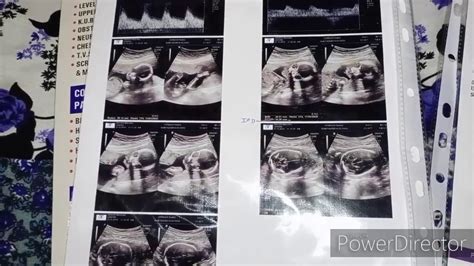 Level 2 ultrasound//ANAMOLY SCAN//kab or q HOTA h//kya isse baby Ka gender pta LG jata h - YouTube