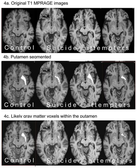 Putamen images from four representative subjects (neurological... | Download Scientific Diagram