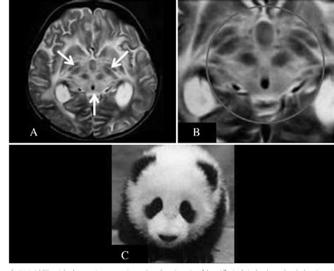 Figure 1 from “Face of the Giant Panda” Sign in Wilson Disease | Semantic Scholar