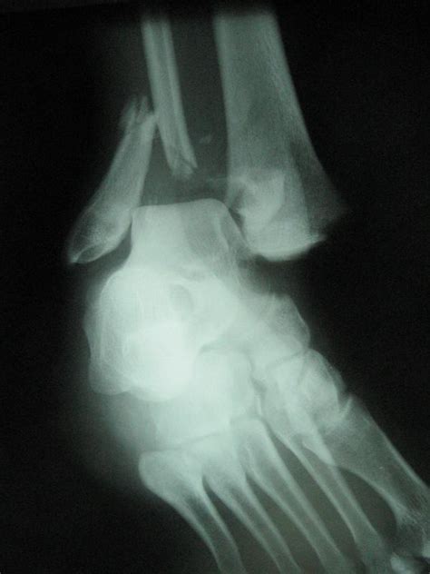 What Is the Distal Fibula? (with pictures)