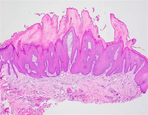 Verruca Plana Histology