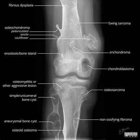 Diagram of different types of bone tumors that can ... | GrepMed