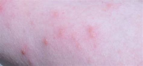 The Best Poison Ivy Rash, Poison Oak Bumps, Sumac Puss, and Bug Bites ...