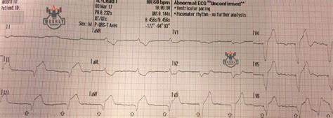 Literature Review: modified Sgarbossa criteria in the diagnosis of ...