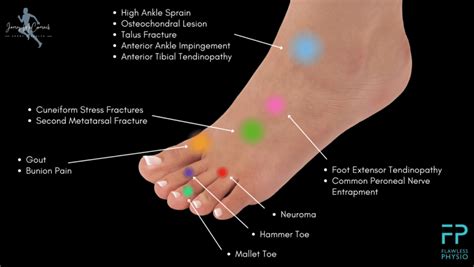 Foot Pain Chart - Find the Cause of Foot Pain with our Diagram