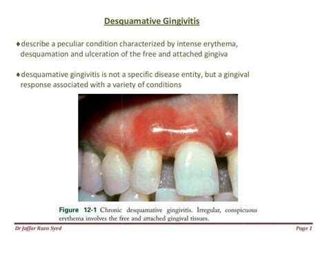 022.desquamative gingivitis