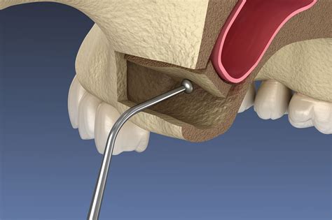 Sinus Lift (Sinus Augmentation) - Sparacino Periodontics