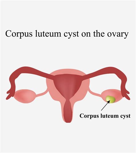 Corpus Luteum Cyst In Pregnancy: Symptoms And Treatment