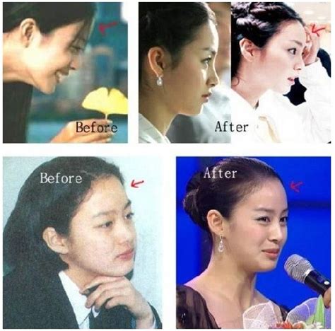 Plastic Surgery Examples: Kim Tae Hee plastic surgery before & after ...