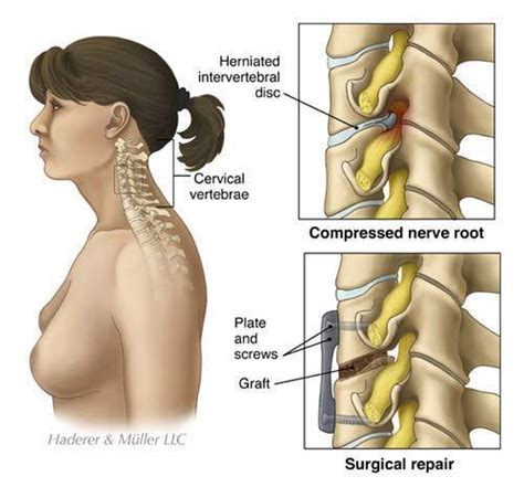 Herniated Disc Cervical/ACDF - Slipped Disc in the Neck - Little Rock ...