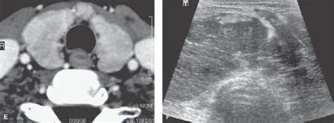 Goiter: Nontoxic Thyroid Gland Enlargement | Radiology Key