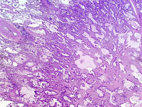 Lung Carcinoma Histology