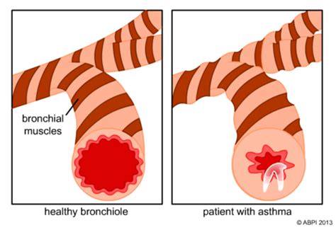 Bronchioles During Asthma | Teaching Resources