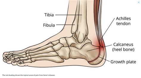 10 Causes of Heel Pain and When to See a Doctor | Raleigh Orthopaedic