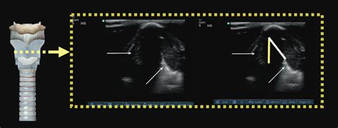 Right vocal cord palsy confirmed by direct sonographic visualisation of ...