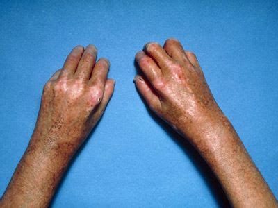 10 Diabetic Skin Conditions: Rash, Sores, and Blisters | Everyday Health