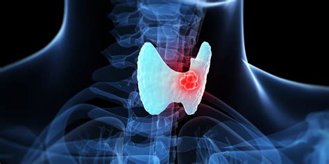 Thyroid Cancer Awareness Month: 5 Important Things to Know About ...