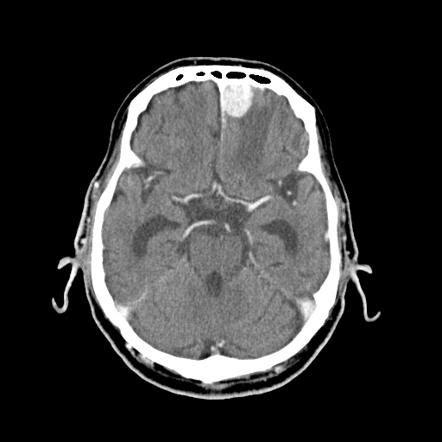 Meningioma Ct Scan