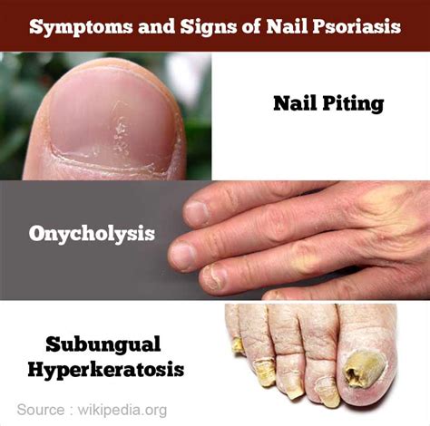 Nail Psoriasis - Causes, Symptoms, Diagnosis, Treatment & Prevention