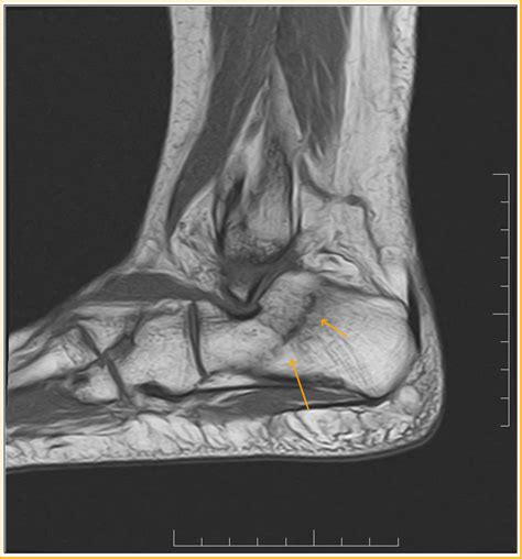 Calcaneal Stress Fracture - Sumer's Radiology Blog