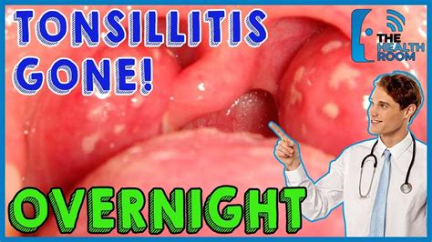 10 Effective Tonsillitis Home Remedies That Work Fast - YouTube