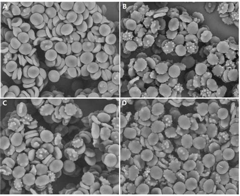 Frontiers | Acanthocytes Identified in Huntington’s Disease