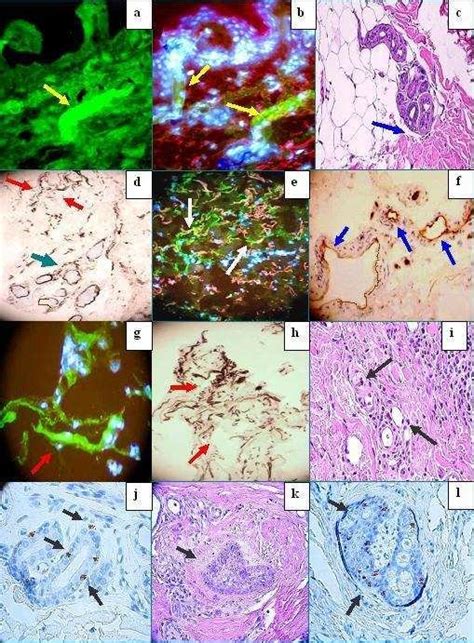 a and b, Positive DIF staining with FITC conjugated fibrinogen ...