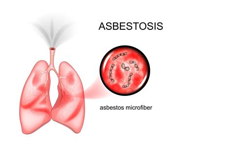 Asbestosis & Medical Malpractice Law | MedicalMalpracticeHelp.com