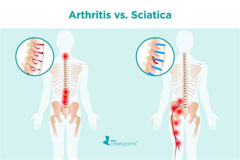 Arthritis vs. Sciatica: Differences in Risk Factors, Symptoms, Treatments