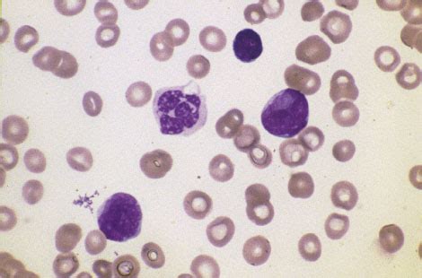 Doctors Gates: Mnemonic for Causes of pancytopenia