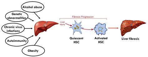 Nanoparticles Targeting Hepatic Stellate Cells for the Treatment of ...