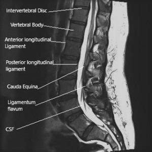 Epidural Injections and Sciatica Nerve - Complete Orthopedics