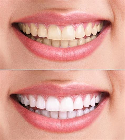 Hydrogen Peroxide For Teeth Whitening - 6 Home Remedies