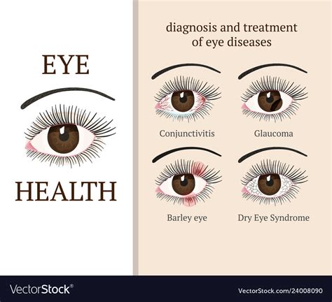 Most common eye problems Royalty Free Vector Image