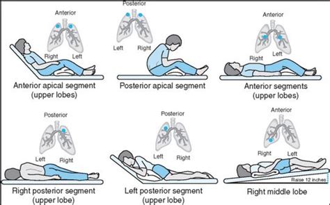 Chest Physiotherapy