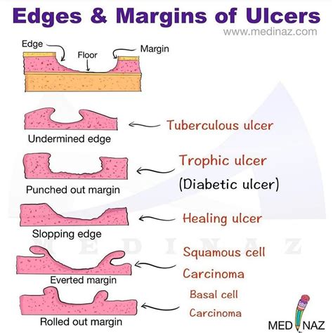 #🩺Ulcers Edges ....... 💊💊💊💊💊💊... - Dr/Mohamed hassan Ashosh | Facebook