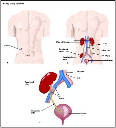 Kidney Transplant - procedure, recovery, test, blood, pain, complications, adults, time